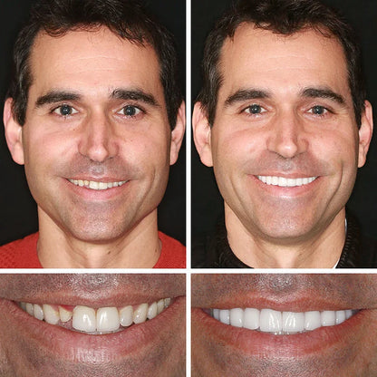 🦷  𝐈𝐦𝐦𝐞𝐝𝐢𝐚𝐭𝐞 𝐝𝐞𝐧𝐭𝐮𝐫𝐞𝐬 - 𝐰𝐞𝐚𝐫𝐚𝐛𝐥𝐞 𝐢𝐧 𝐣𝐮𝐬𝐭 𝐭𝐡𝐫𝐞𝐞 𝐦𝐢𝐧𝐮𝐭𝐞𝐬 | 𝐒𝐦𝐢𝐥𝐞 𝐰𝐢𝐭𝐡 𝐂𝐨𝐧𝐟𝐢𝐝𝐞𝐧𝐜𝐞🔥