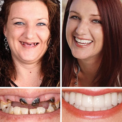🦷  𝐈𝐦𝐦𝐞𝐝𝐢𝐚𝐭𝐞 𝐝𝐞𝐧𝐭𝐮𝐫𝐞𝐬 - 𝐰𝐞𝐚𝐫𝐚𝐛𝐥𝐞 𝐢𝐧 𝐣𝐮𝐬𝐭 𝐭𝐡𝐫𝐞𝐞 𝐦𝐢𝐧𝐮𝐭𝐞𝐬 | 𝐒𝐦𝐢𝐥𝐞 𝐰𝐢𝐭𝐡 𝐂𝐨𝐧𝐟𝐢𝐝𝐞𝐧𝐜𝐞🔥